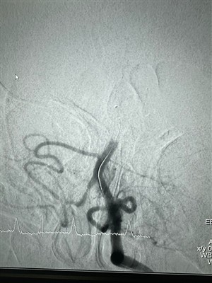 Um novo caso para o Dredger Stent Retriever